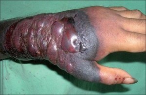 Cánh tay bị hoại tử của một bệnh nhân Ebola. 
