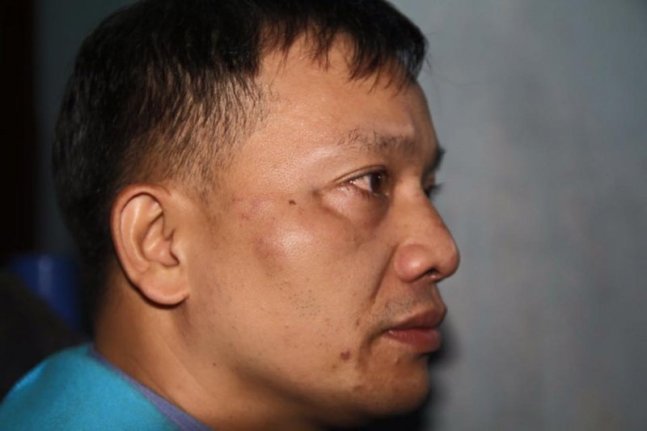 Khuôn mặt luật sư Đài bị sưng to sau khi bị hành hung. Ảnh FB Dũng Nguyễn Quân. 